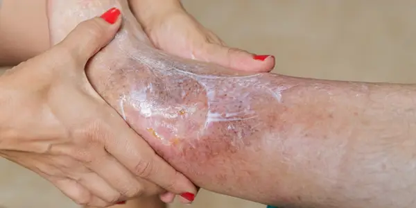 Úlceras varicosas: cuando las várices hablan más fuerte.