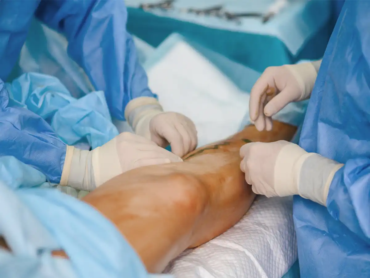 Cirugía arterial periférica en piernas