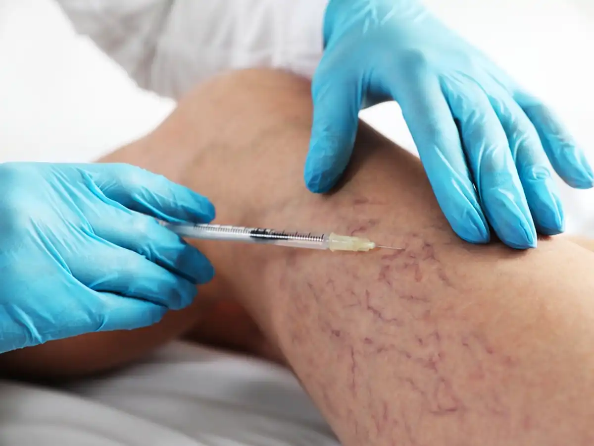 Escleroterapia en Quito - Dra. Soledad Gómez