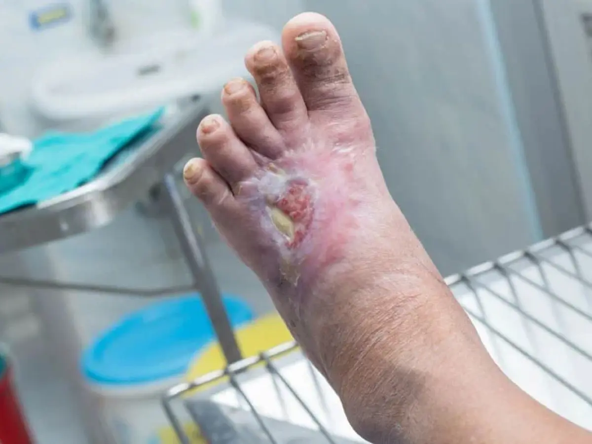 Pie diabético tratado por cirujana vascular en Quito