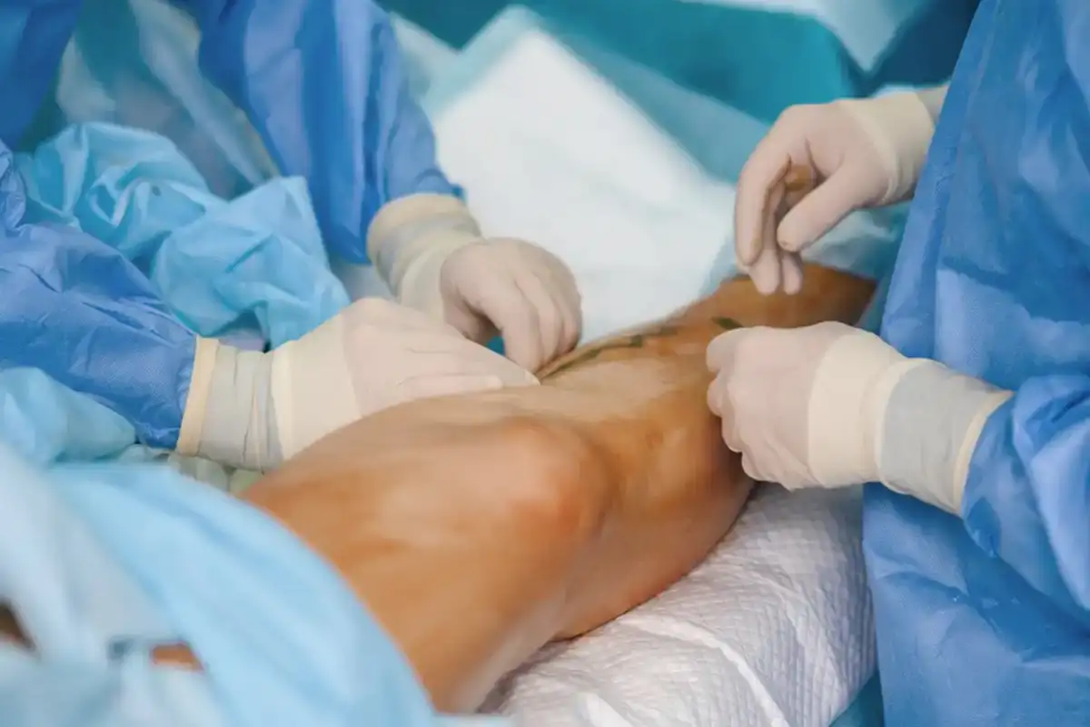 Procedimiento de revascularización arterial en quirófano