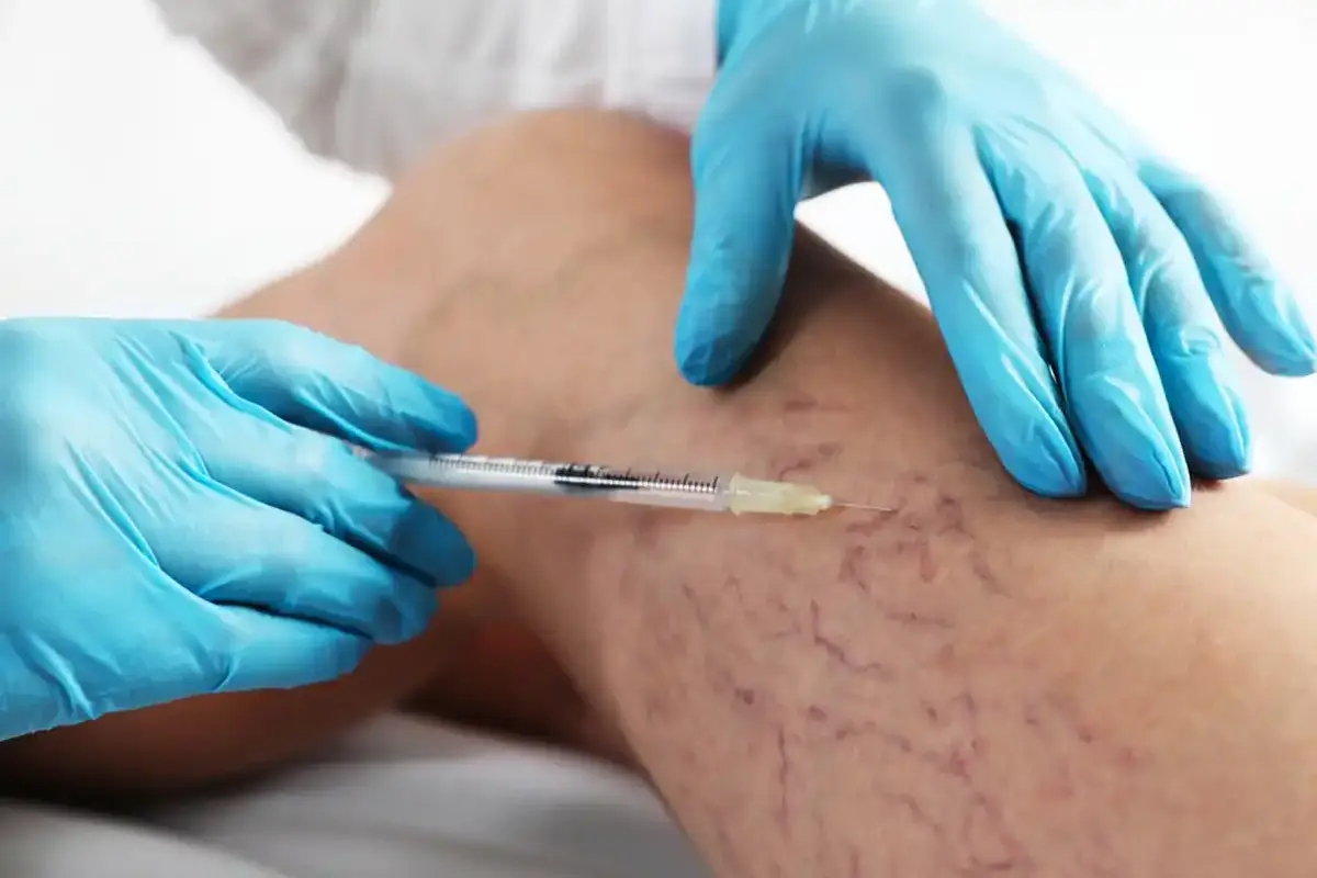 Aplicación de escleroterapia en la pierna de una paciente
