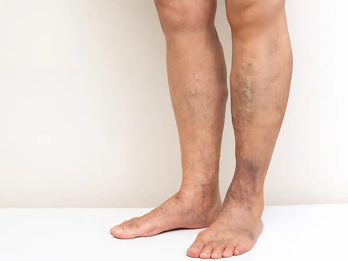 Evaluación de la circulación venosa de las piernas en consulta