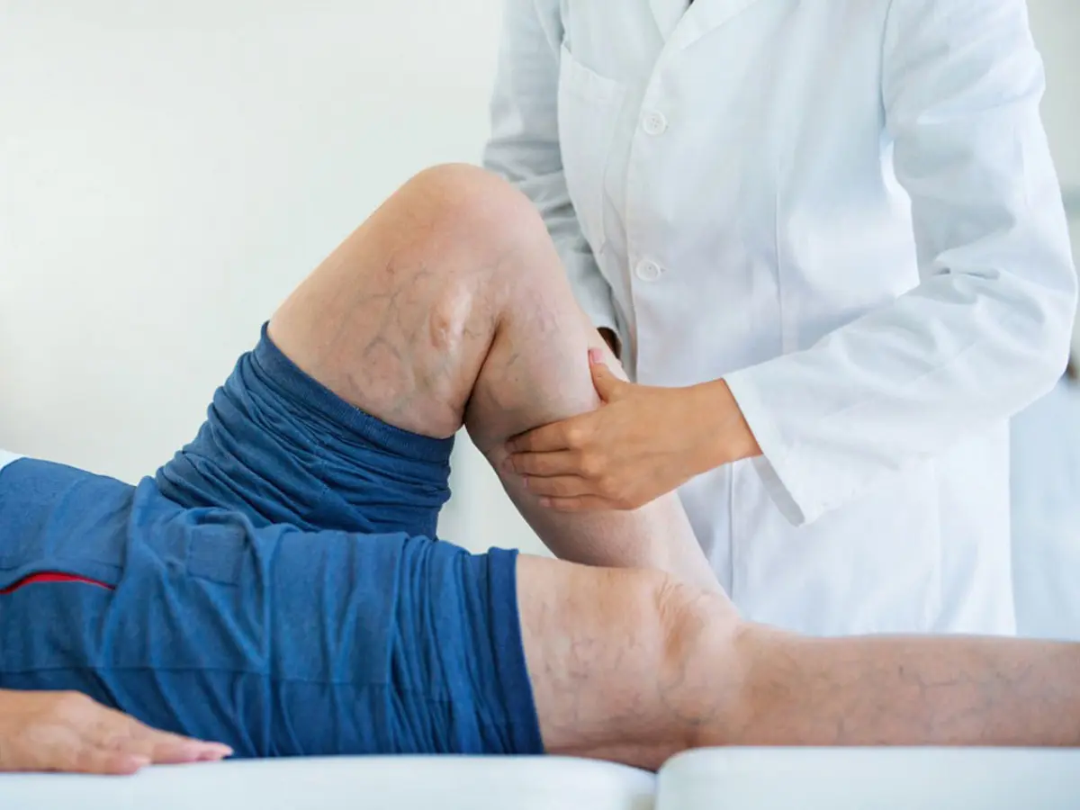 Tratamiento de várices en Quito - Dra. Soledad Gómez Pérez