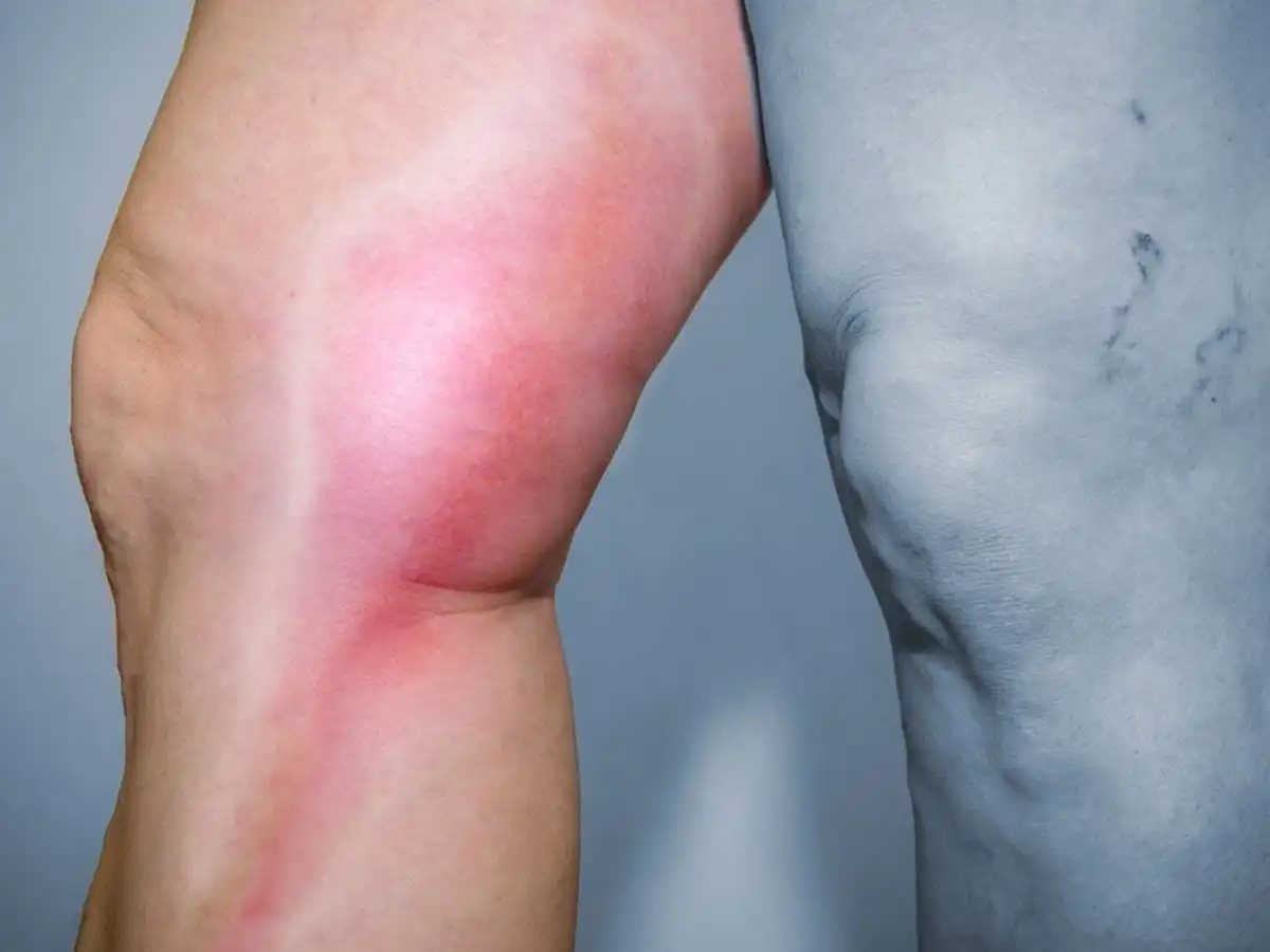 Trombosis venosa profunda en las piernas