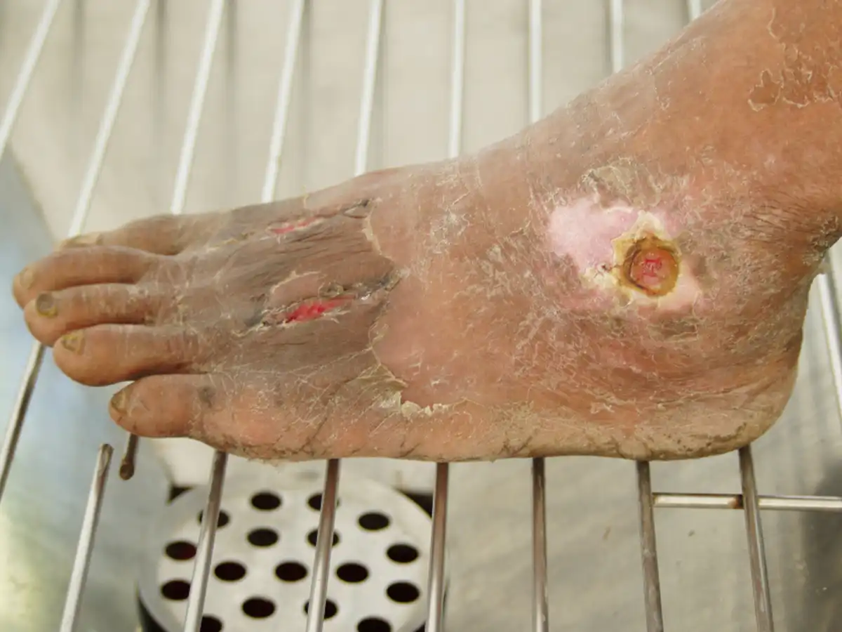 Tratamiento de úlceras venosas en Quito - Dra. Soledad Gómez