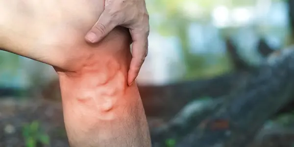 Varicotrombosis: más que várices, una amenaza real.